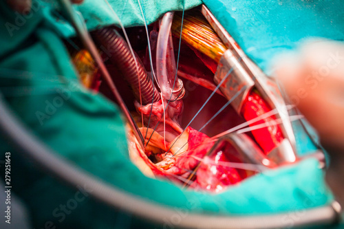 Mitral valve orifice in surgeon view. The pathologic mitral valve was dissected. The mitral valve ring was prepare before mitral valve replacement procedure perform. photo