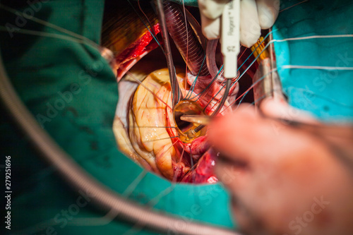Mitral valve orifice in surgeon view. The pathologic mitral valve was dissected. The mitral valve ring was prepare before mitral valve replacement procedure perform.