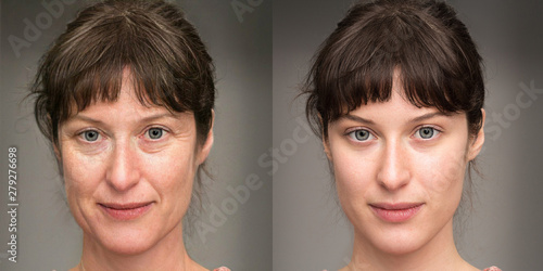 Billede på lærred Woman before and after a rejuvenation treatment