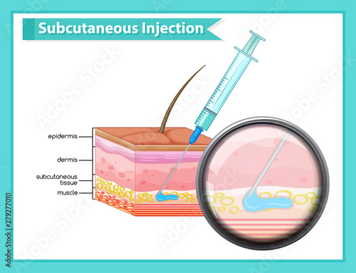Scientific medical illustration of subcutaneous injection photo