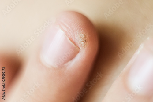 wart, papilloma on a childs finger. Macro shot, selective focus, close-up, space for text. Dermatological problems with the skin