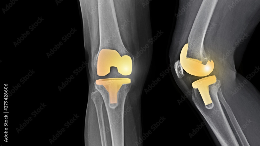 Film Xray knee radiograph showing degenerative osteoarthritis (OA knee