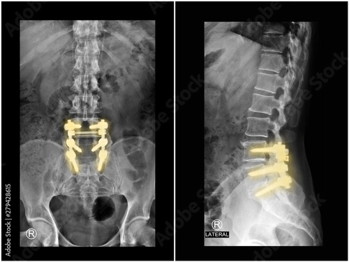 Film x-ray radiograph lumbar spine showing spinal stenosis treated by decompressive laminectomy with fusion and  fixation with pedicle screw and rod . Highlight on implant. Medical technology concept.