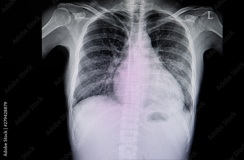cardiomegary dodle lumen catn minimal effusdion cardiomegary dodle lumen catn minimal effusdion