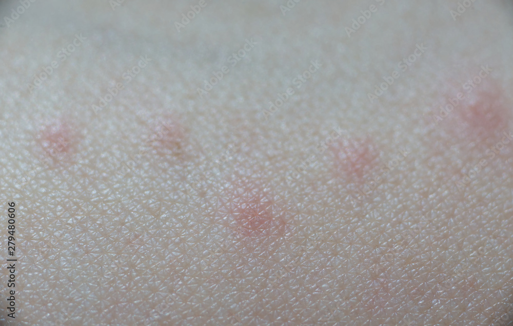 Fototapeta premium Red wheal on skin that effect from insect bite