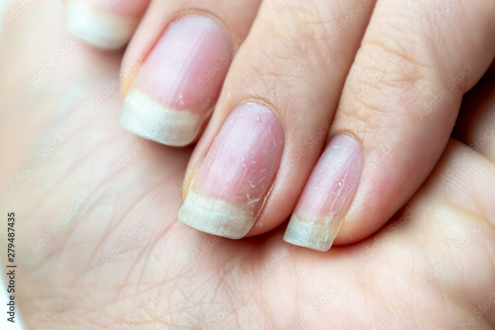 Close up of damaged nails that have problem after doing manicure. Health and beauty problem. Close up of damaged nails that have problem after doing manicure. Health and beauty problem.