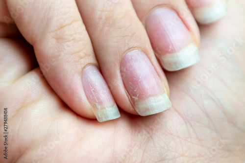 фотографія Damaged nails that have problem after doing manicure