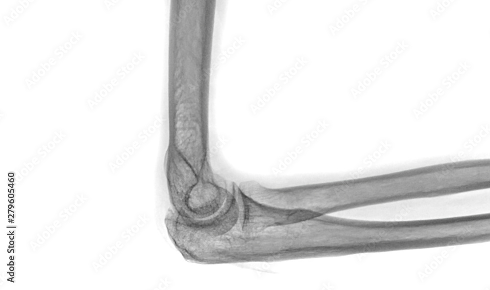 Xray Elbow or Radiography of Right elbow Lateral view for diagnostic