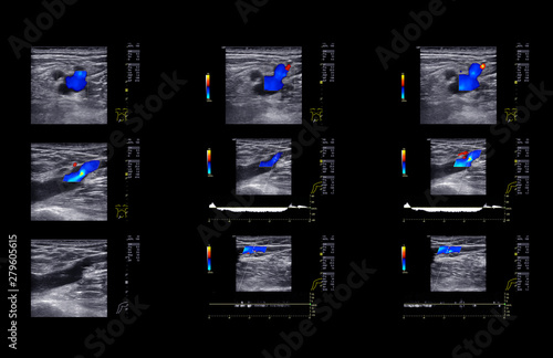 Ultrasound doppler for finding  deep vein thrombosis of lower extremity. photo