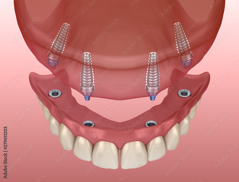 Maxillary prosthesis with gum All on 4 system supported by implants. Medically accurate 3D illustration of human teeth and dentures Maxillary prosthesis with gum All on 4 system supported by implants. Medically accurate 3D illustration of human teeth and dentures