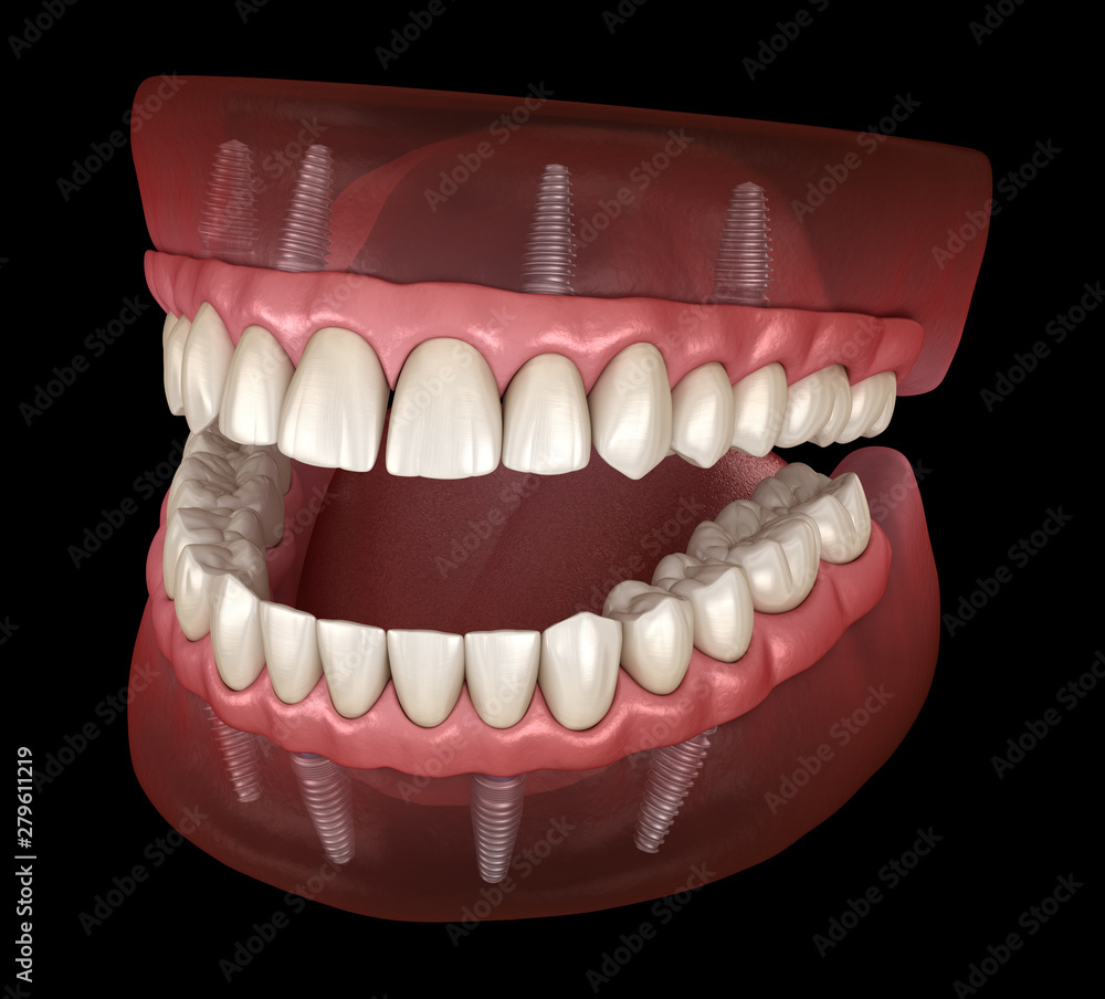 Obraz premium Maxillary and Mandibular prosthesis with gum All on 4 system supported by implants. Medically accurate 3D illustration of human teeth and dentures