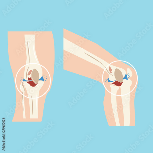Damaged human knee joint set design vector