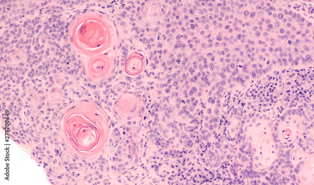Lung Cancer Photomicrograph of a CT (CAT) scanguided needle core