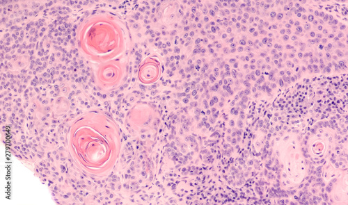Lung Cancer: Photomicrograph of a CT (CAT) scan-guided needle core biopsy showing pulmonary squamous cell carcinoma, a type of non-small cell carcinoma usually associated with smoking.    photo