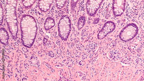 Photomicrograph of a carcinoid tumor, a type of neuroendocrine tumor (NET), which presented as a colon polyp during routine colonoscopy.  Spread to liver can cause symptoms of carcinoid syndrome. photo