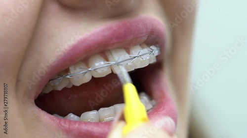 Cleaning of patient's teeth brackets in dental clinic