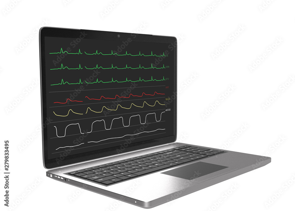 Monitoring display of patient vital signs on laptop computer Monitoring display of patient vital signs on laptop computer