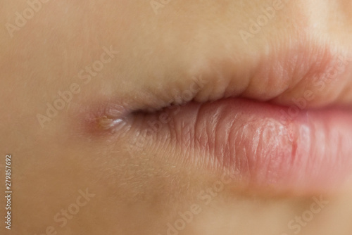 Photography skin problems, angulitis, angular stomatitis, angular cheilitis  a disease of th