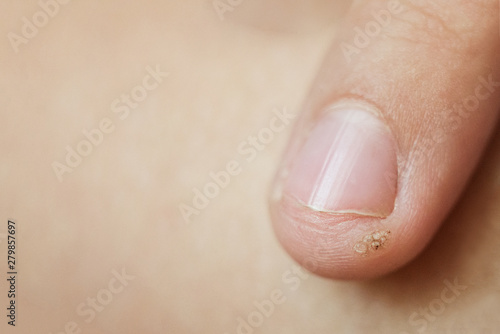 wart  papilloma on a childs finger. Macro shot  selective focus  close-up  space for text. Dermatological problems with the skin