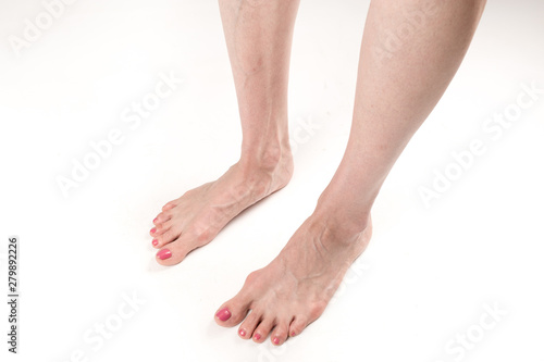 Fototapeta Naklejka Na Ścianę i Meble -  female legs with transverse flat feet and protruding veins