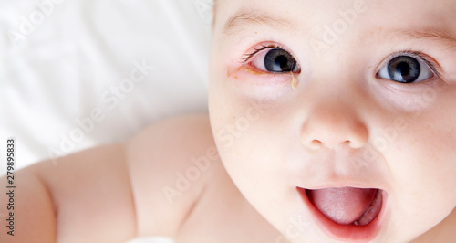 An infant with soured eyes suffers from conjunctivitis photo