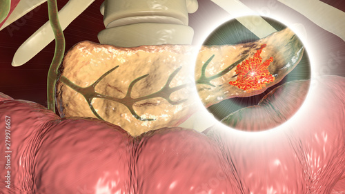 Pancreatic cancer, malignant tumor of pancreas, 3D illustration photo