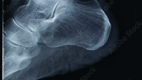 Vertical tracking shot of an x-ray of the bones of the human foot, in lateral view.