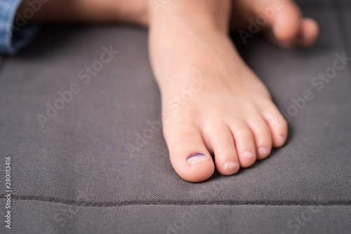 Closeup of a little kindergarten boy's bare feet and toenails which got bruised under thumb toe from accident. Kids injured, Health Insurance, First-aid, Child care, Growing up concept.