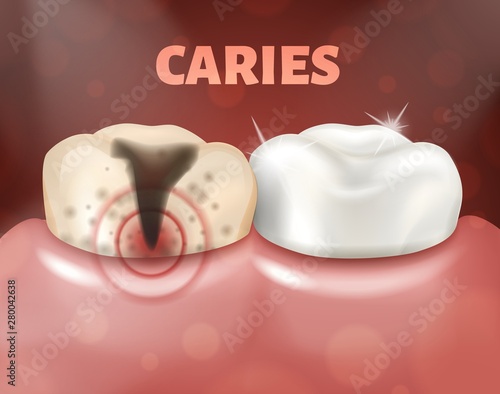 Tooth with caries and healthy tooth. 3d realistic illustration of dental disease. Deep caries on a sick tooth