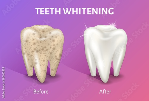 Teeth whitening in realistic 3d vector illustration. Tooth before and after whitening.