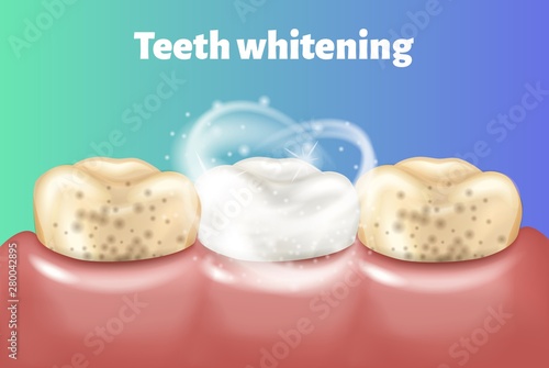 Teeth whitening concept. Dirty tooth and other is clean and white.