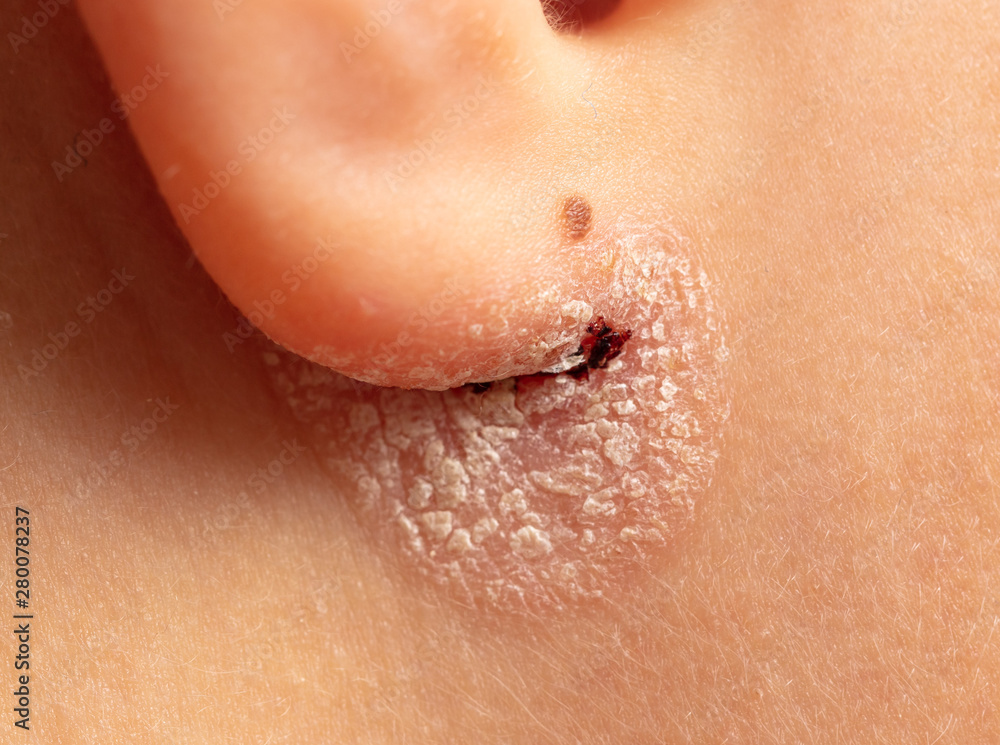 Inflamed wound in the boy's ear Inflamed wound in the boy's ear