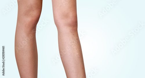 The scar on the leg. Bone fracture or tumor removal. Recobvery. isolated medical on white background photo