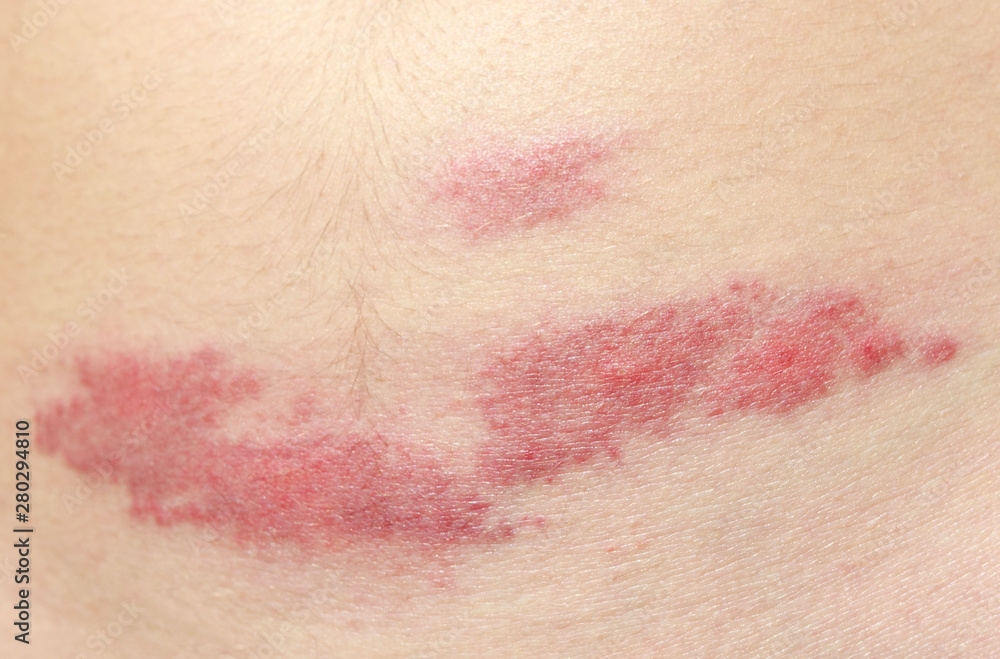 Fototapeta premium midge mosquito bite. reaction to the bite of midges. allergy. danger of insect bites in the summer. red spot at the bite site after a day