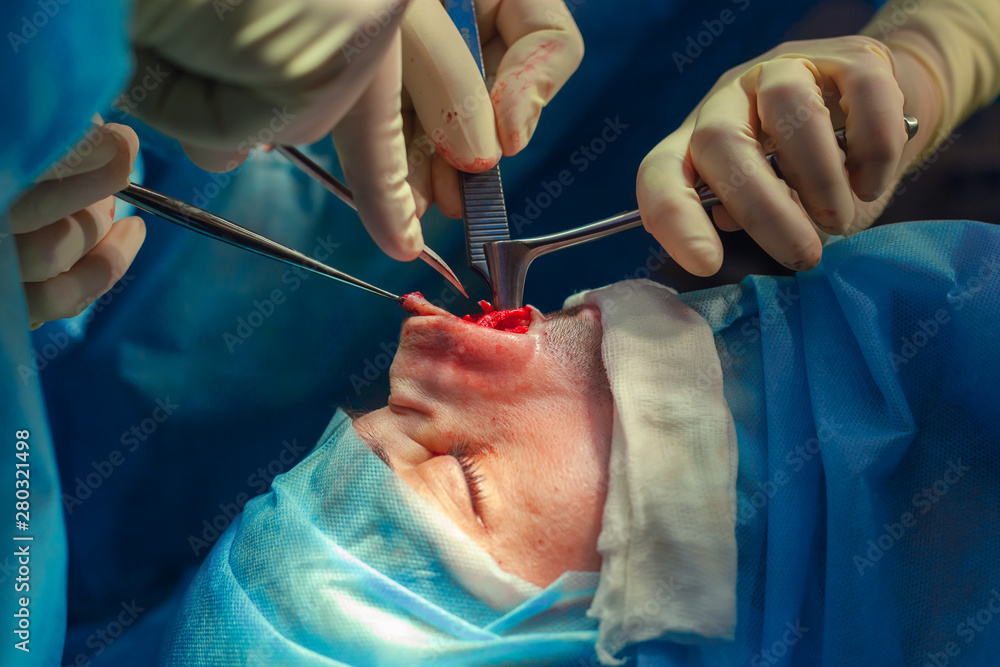 Surgeon and his assistant performing cosmetic surgery on nose in hospital operating room. Nose reshaping, augmentation. Rhinoplasty. Surgeon and his assistant performing cosmetic surgery on nose in hospital operating room. Nose reshaping, augmentation. Rhinoplasty.
