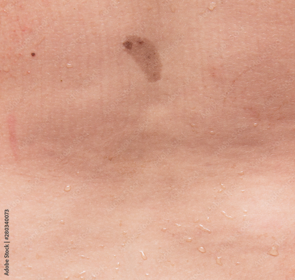 birthmark birthmark on the skin