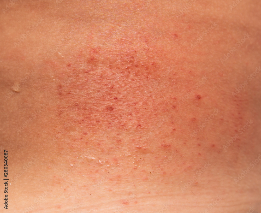 Fototapeta premium allergic rash on the skin of the back