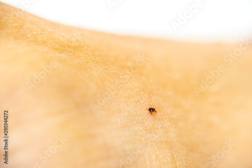 Tick on human skin sucking blood from leg