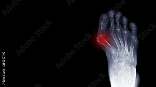 Film x-ray foot radiograph show Hallux valgus deformity or Bunion disease with free copy space and dark background. The patient has toe pain symptom. This cause shoe wearing and cosmetic problem.