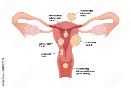 Types of uterine fibroids. Vector medical illustration with inscroptions isolated on white background. photo