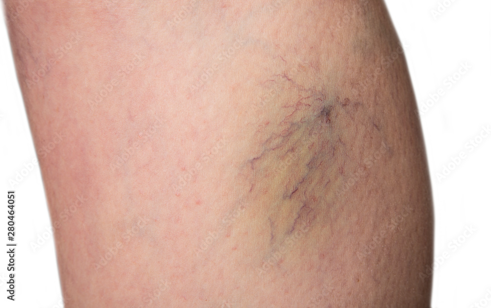 Bursted capillaries on a woman leg Bursted capillaries on a woman leg