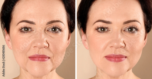 Tableau sur toile Beautiful mature woman before and after biorevitalization procedure on beige bac