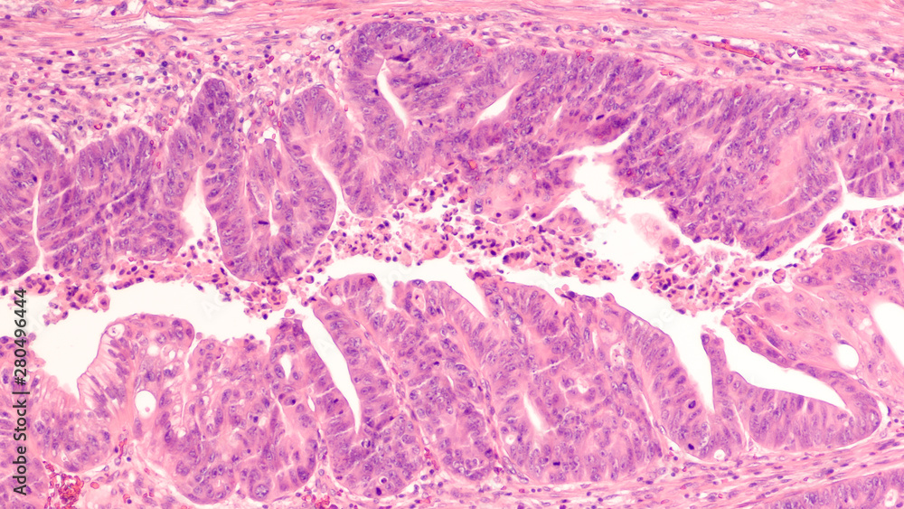 Colon Cancer Photomicrograph (microscopic image) of an invasive
