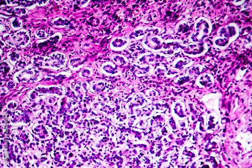 Histopathology of biliary liver cirrhosis, light micrograph, photo under microscope