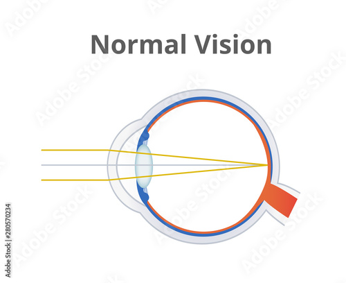 Vector illustration of normal vision – anatomy of healthy eye ball without disorder. The light is focused on the retina. Medical science illustration is isolated on a white background.