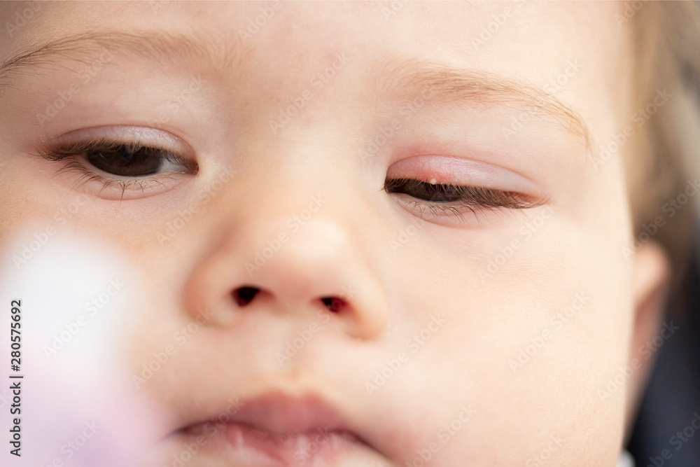 White pimple on the eyelid of a small child close-up. Inflammation of the eye milium conjunctivitis White pimple on the eyelid of a small child close-up. Inflammation of the eye milium conjunctivitis