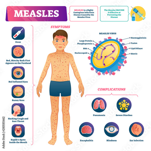 Measles vector illustration. Labeled medical virus disease medical scheme.