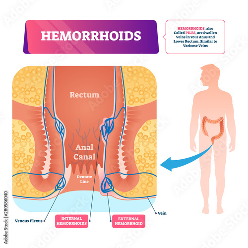 Hemorrhoids vector illustration. Labeled anatomical vascular piles scheme.
