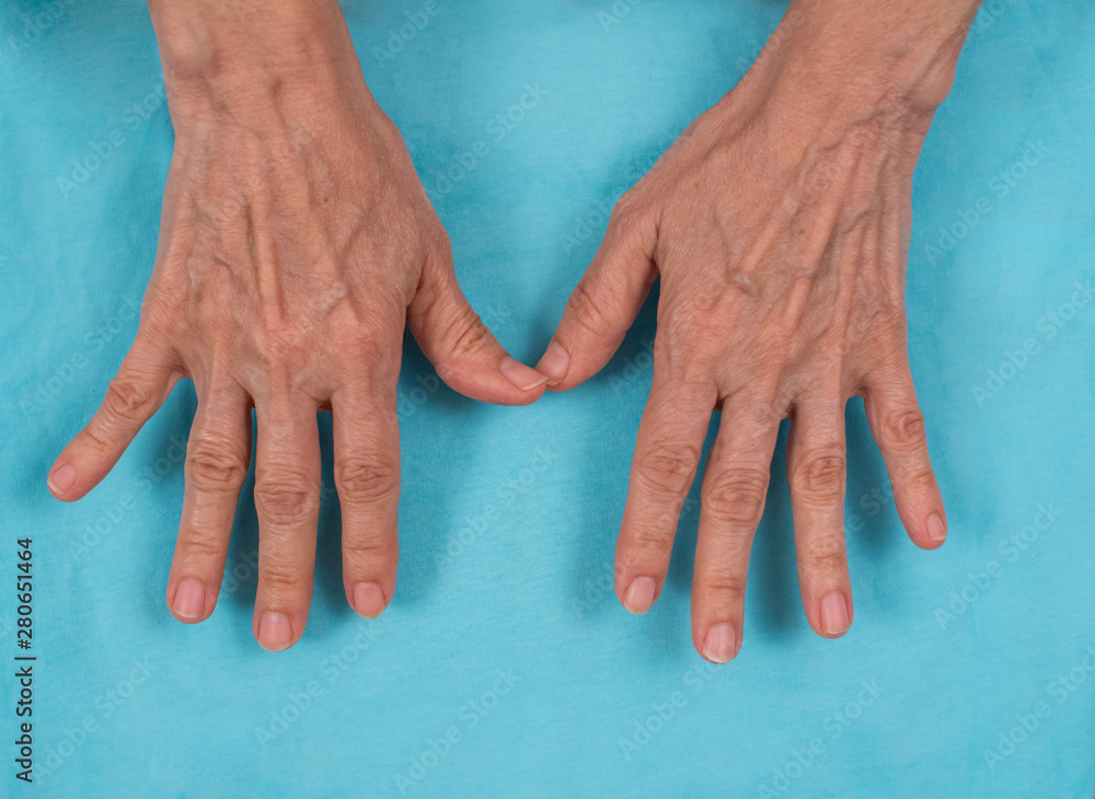 Inicial change in rheumatoid arthritis. Ulnar deviation Stock Photo