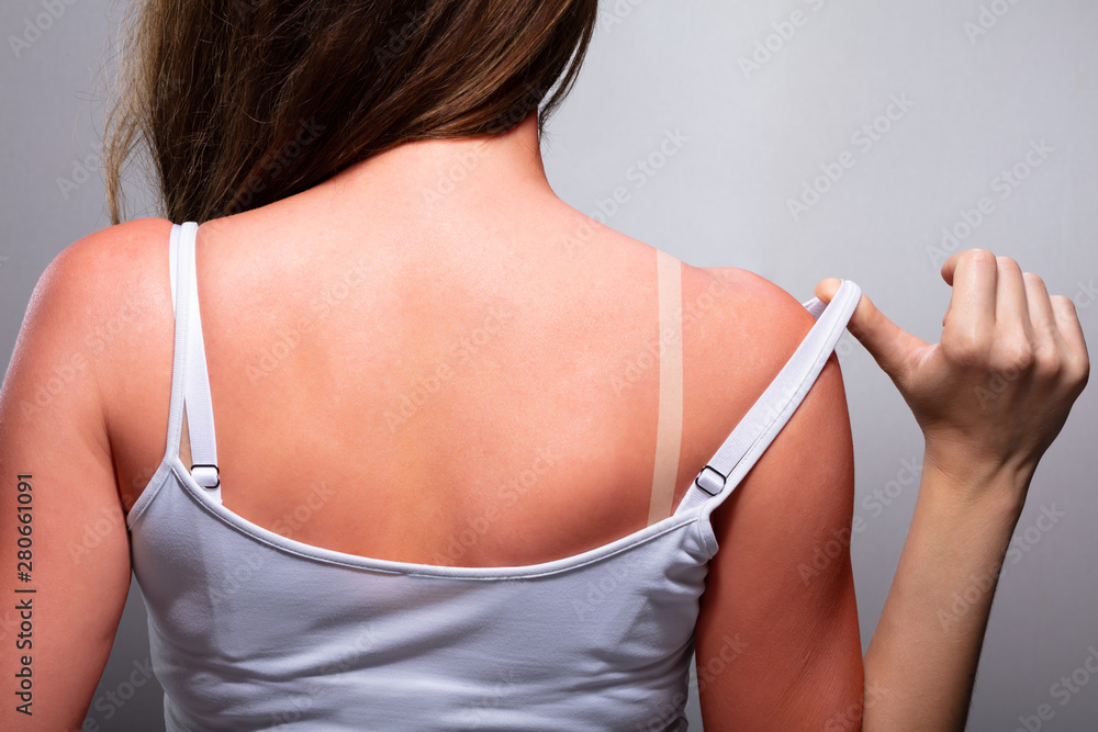 Woman with sunburn - obrazy, fototapety, plakaty 